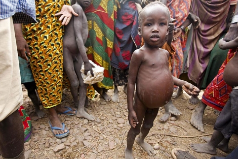 Un niño con problemas de malnutrición. | Efe
