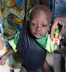 Malnutricin. | Cruz Roja
