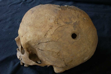 Crneo trepanado de un varn del siglo XIII, hallado en Soria. | Beln Lpez Martnez