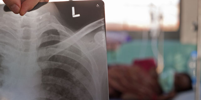 Radiografa de un enfermo de tuberculosis atendido por la Fundacin Vicente Ferrer. | Quim Botey | FVF