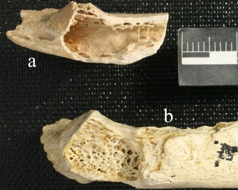 Restos seos del Neanderthal de hace 120.000 aos con cncer. | PLOS ONE