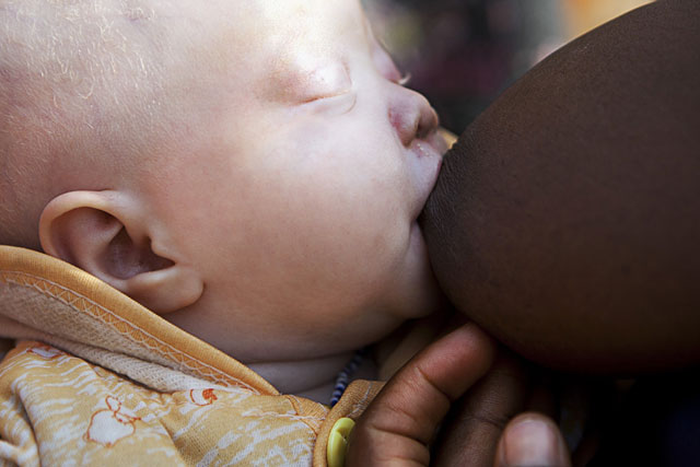 Una mujer amamanta a su beb albino en Kabanga . | Ana Palacios