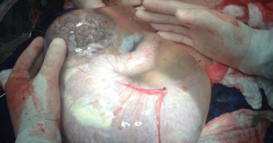Nacimiento de un beb sin ruptura del saco amnitico.