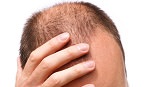 Alopecia de un hombre