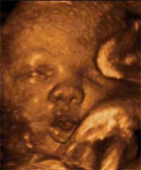 feto de 34 semanas