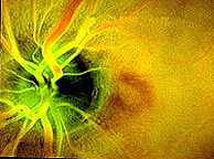 Imagen de una retina sana