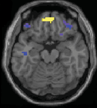 El crtex frontal presenta ms actividad antes de la menstruacin. (Foto: PNAS)