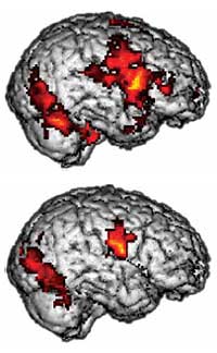 Cerebro de un niño normal (arriba) y de un niño con autismo (abajo). La actividad del cerebro autista en las áreas marcadas es menor. (Foto: Nature Neuroscience)