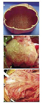 Molde donde se colocan las células de cultivo (A), que posteriormente se cubre con epiplón (B) y se une a la vejiga originaria (C). (Foto: 'The Lancet')