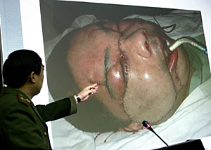 El cirujano plástico Guo Shuzhong muestra una imagen del paciente trasplantado (Foto: AFP)