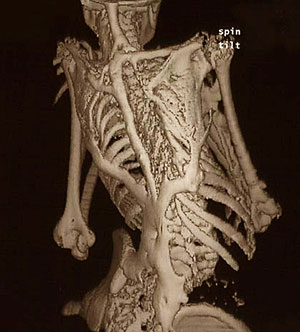 La espalda de un paciente con esta enfermedad (Foto: AP | University of Pennsylvania and Nature Genetics)