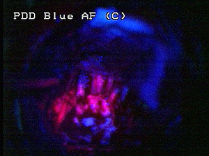 En rojo, el tumor iluminado en el cerebro teido de azul (Imagen: Walter Stummer)