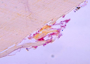 Imagen microscpica del hongo Fusarium, causante de la infeccin (Foto: CDC)