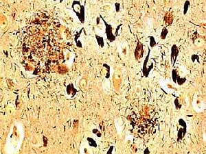 Imagen de un cerebro afectado por mal de Alzheimer. (Foto: cortesa del CBM)