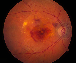 Imagen por angiografía de un ojo con degeneración macular (Foto: NEI)