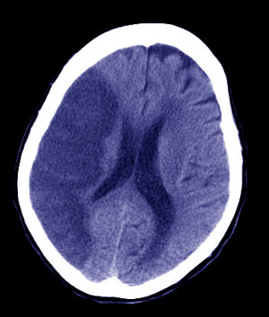 La imagen muestra una trombosis cerebral, la parte sombreada a la izquierda. (Foto: R.B.)