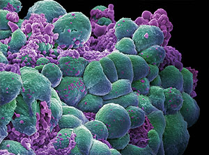 Una muestra de clulas de un cncer de mama. (Foto: Annie Cavanagh | Wellcome Trust Medical)