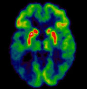 PET con PiB de un cerebro con Alzheimer.