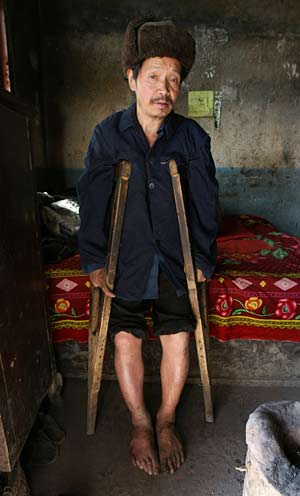 Zhang Huaixiang, granjero de Guizhou, sufre fluorosis esquelética (Fotos: AFP)