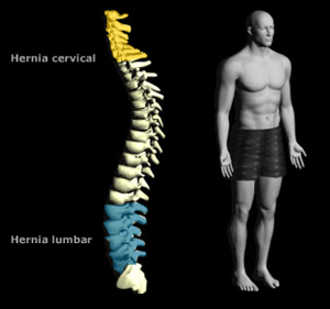 Vea el grfico sobre la hernia discal (Imagen: Artur Galocha)