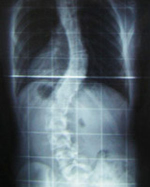 Radiografa de una columna con escoliosis