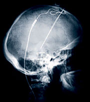 Radiografa del paciente con los electrodos implantados (Foto: Cleveland Clinic)