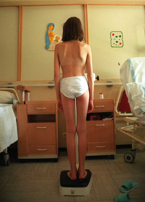Paciente de la unidad de trastornos alimentarios del Hospital Nio Jess. (Foto: Begoa Rivas)