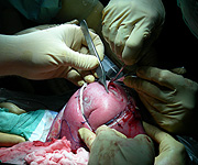 Los cirujanos intervienen al bebé (de perfil y de nalgas).
