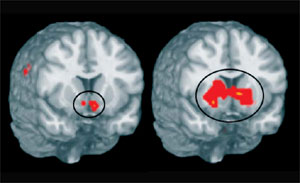 La imagen muestra las diferencias entre el cerebro de una mujer sana (izquierda) y una con anorexia (derecha) ante una recompensa. (Foto: Universidad de Pittsburg)