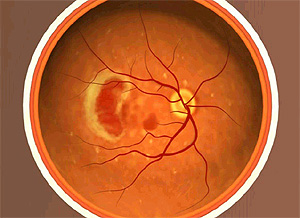 Ojo afectado por la degeneracin macular (Foto: National Eye Institute) | Vea el vdeo