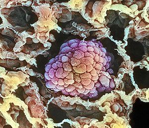 Clula de un cncer de pulmn (Foto: Photo Science Library)