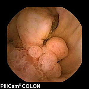 Imagen de un tumor en el colon. Pulse para ver el grfico. (Foto: Given Imaging)
