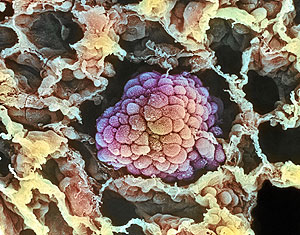 Imagen microscpica de un tumor de pulmn. (Foto: Science Photo Library)
