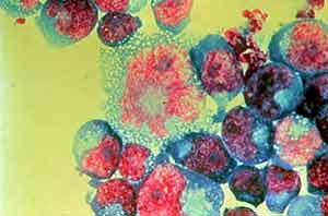 Clulas T infectadas por el VIH. (Foto: cortesa del Dr. Tom Folks, NIAID | NIH)