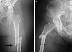 Radiografas de fracturas de fmur. (Imagen: Journal of Orthopaedic Trauma)
