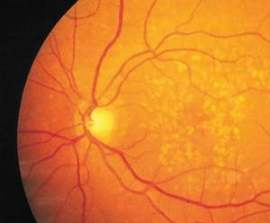 Imagen por angiografa de un ojo con degeneracin macular (Foto: NEI)
