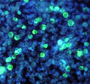 Clulas cancergenas infectadas por el virus Epstein-Barr (Foto: CDC)