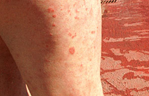 Habitual inflamacin de la piel causada por psoriasis. (Foto: Rosa La)