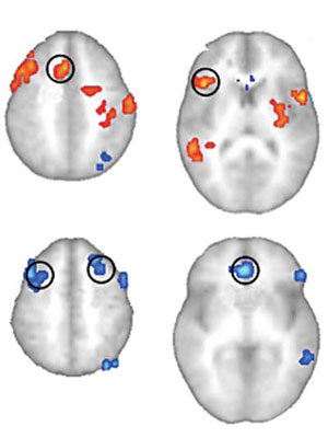 Imgenes de los cerebros durante el ensayo. (Foto: 'Archives of General Psychiatry')