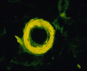 Un anillo amiloide en el cerebro de un paciente con Alzheimer. (Foto: James Powers, Rochester)