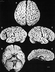 Cinco vistas diferentes del cerebro de Albert Einstein.