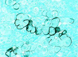 Clulas tumorales de un cncer de pncreas (Foto: NCI)
