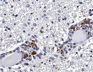 Los 'lunares' marrones muestran la angiotensina en una lesin cerebral de un paciente con esclerosis (Foto: L. Steinman)