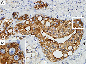 Clulas en un tumor maligno de prstata (de color marrn), infectadas por el virus. (Foto: PNAS)
