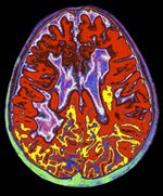 Cerebro con esclerosis mltiple. (Imagen: El Mundo)
