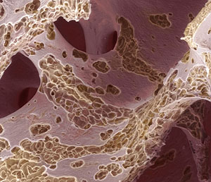 Tejido seo deteriorado por la osteoporosis. (Foto: Science Photo Library)