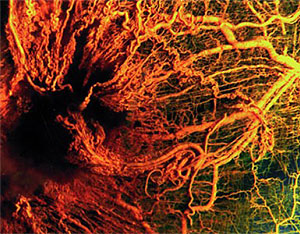 Cientos de nuevos vasos sanguíneos crecen para nutrir un cáncer nacienteM; zona oscura a la izquierda. (Foto: childrenshospital.org)