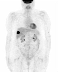 El PET revela una metástasis hepática, una captación oscura en el costado dcho. El resto de captaciones representan tejidos normales; de arriba a abajo, el cerebro, la musculatura de la laringe, el ventrículo izquierdo del corazón y ambos riñones (Foto: Asociación Andaluza de Cirujanos)