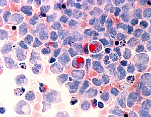 Células de un paciente con leucemia al microscopio (Foto: NCI)