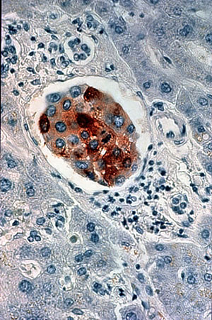 Imagen histolgica de un tumor de mama. (Foto: Instituto Nacional del Cncer de Estados Unidos)